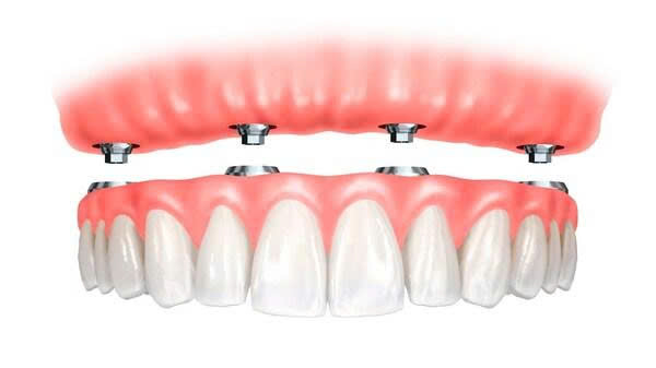 Combo Trồng Răng Implant Toàn Hàm