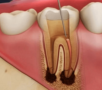 Điều trị tủy