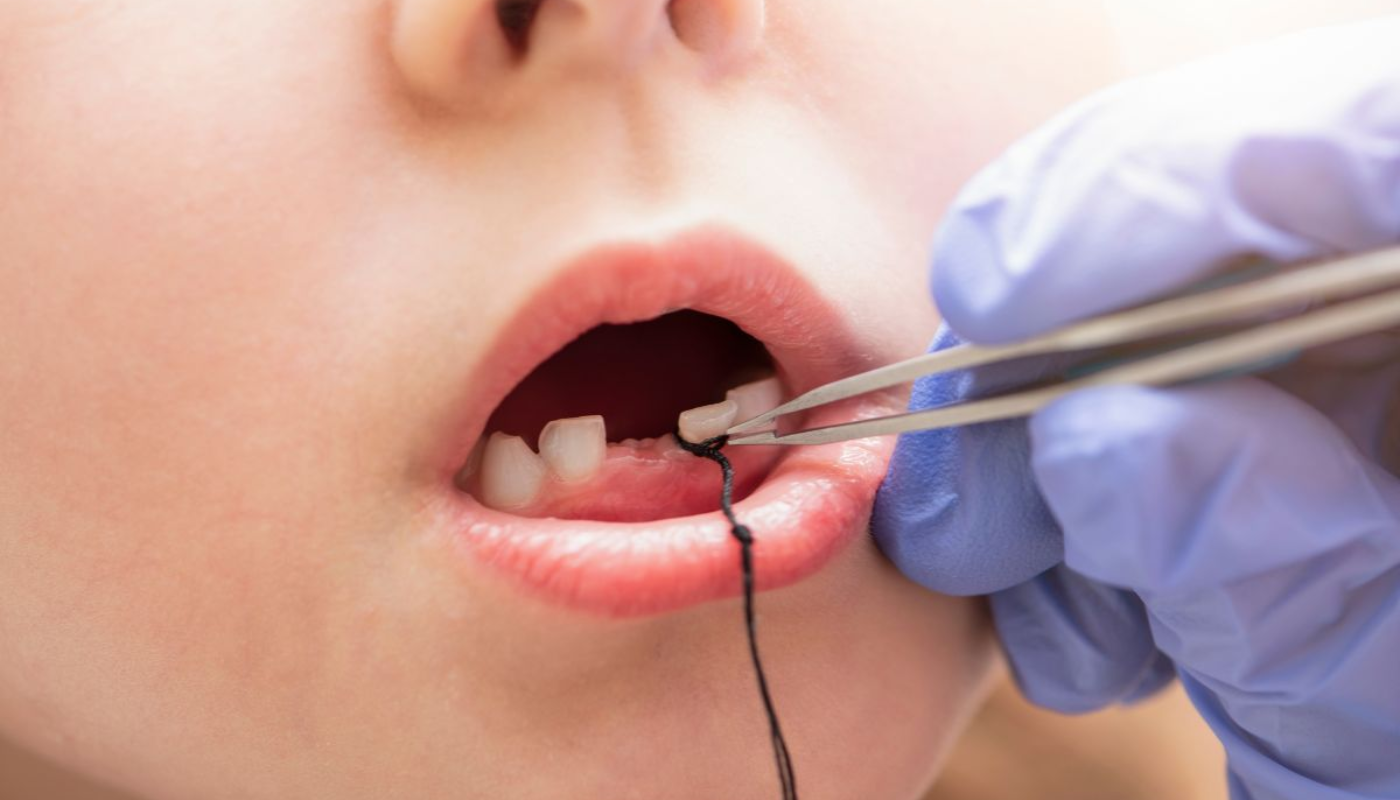 Nhổ răng sữa (Bôi tê)