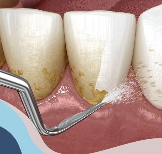 Phẫu Thuật Nha Chu