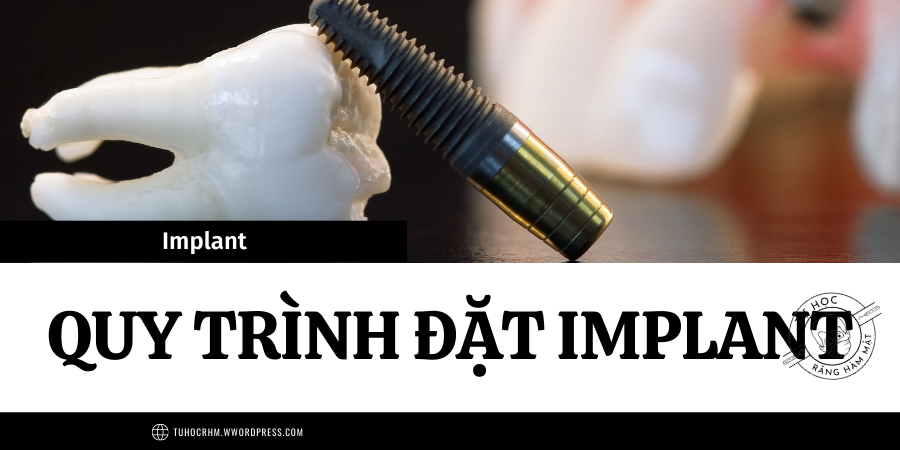 Quy Trình Đặt Implant Nha Khoa: Kỹ Thuật & Hướng Dẫn Chi Tiết (2026)