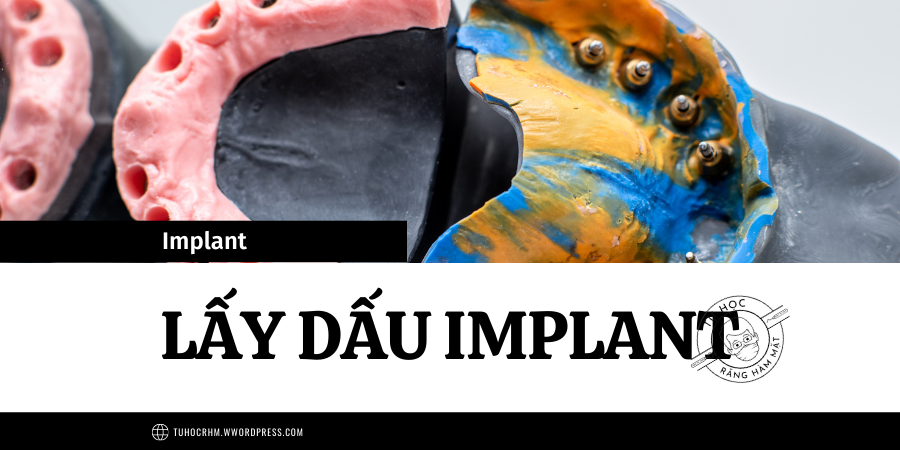 Lấy Dấu Implant: Kỹ Thuật Khay Mở, Khay Đóng & Scan 3D (2026)