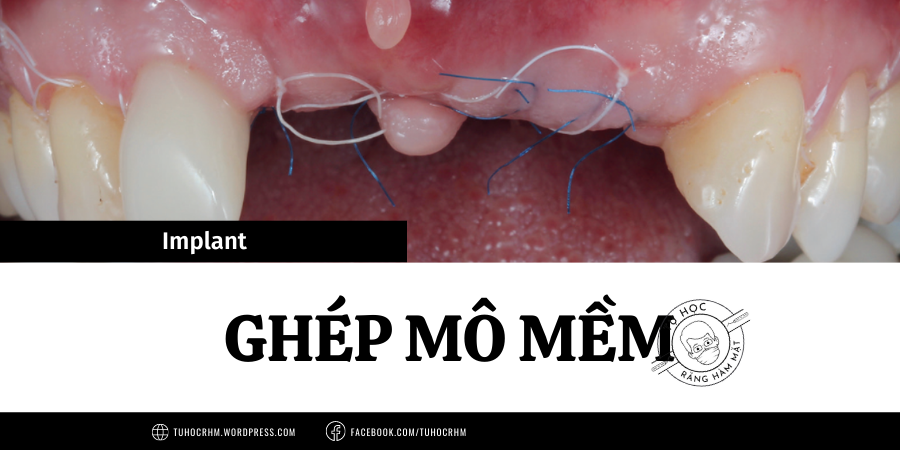 Ghép Mô Mềm Trong Cấy Ghép Implant: Kỹ Thuật & Nguyên Tắc (2026)