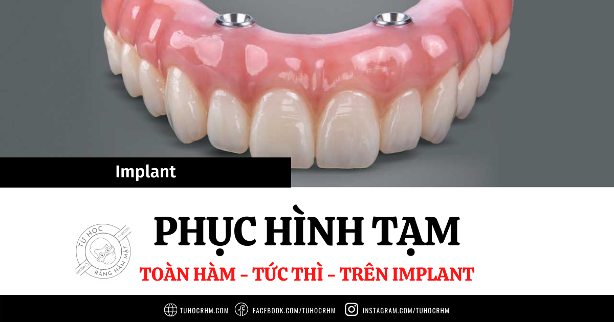 Phục Hình Tạm Tức Thì Trên Implant: Kỹ Thuật Trực Tiếp P1 (2026)