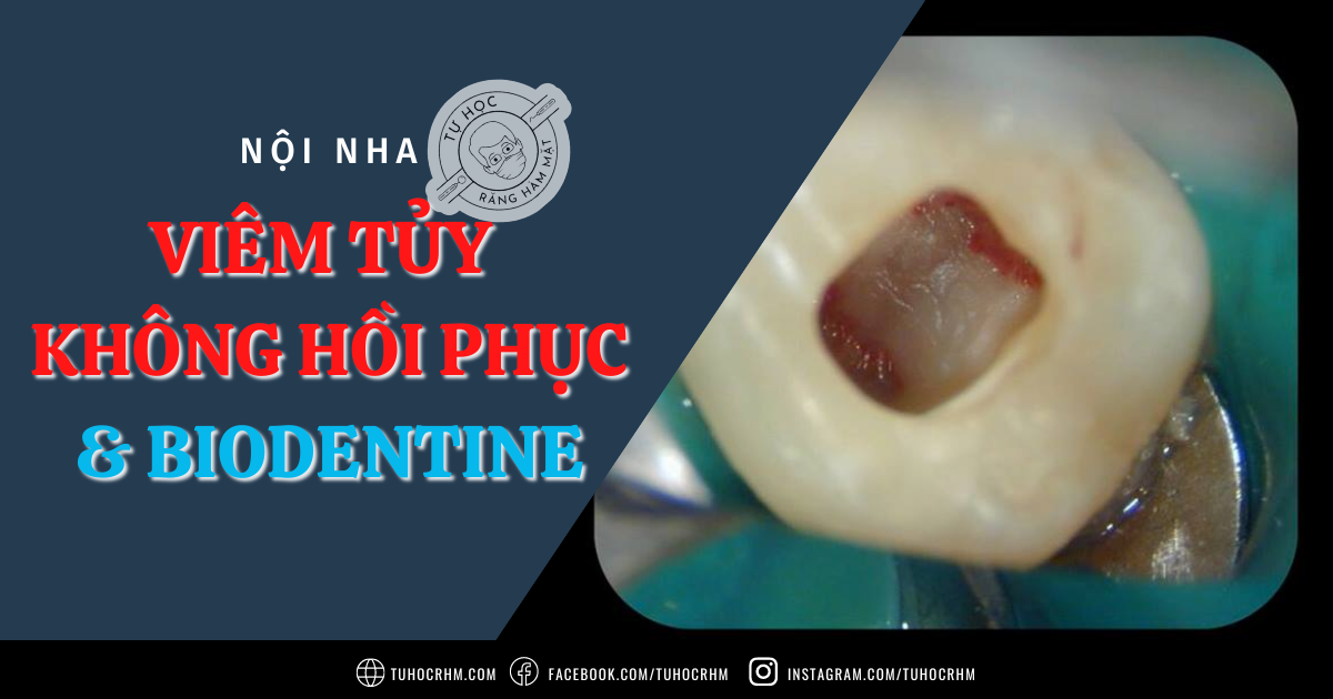 Biodentine Trong Điều Trị Viêm Tủy Không Hồi Phục: Ứng Dụng (2026)