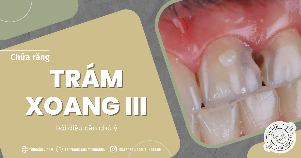 Trám Xoang III Composite: Quy Trình Vát Men & Đặt Khuôn (2026)