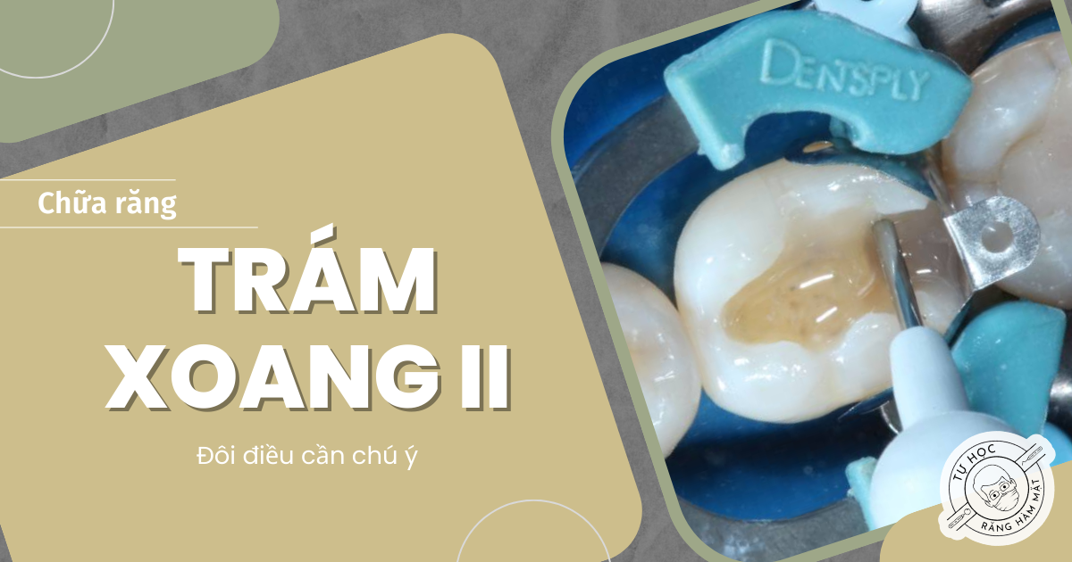 Trám Xoang II Composite: Kỹ Thuật CBT, Đặt Khuôn & Chêm Chuẩn Y Khoa