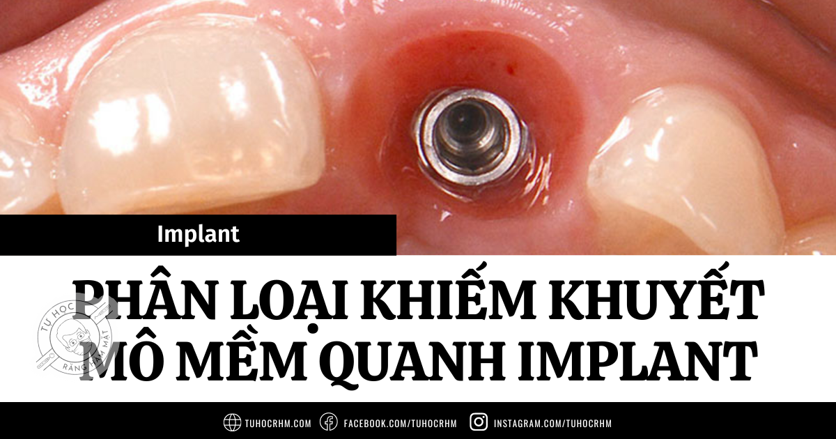 Phân Loại Khiếm Khuyết Mô Mềm Quanh Implant (PSTD) Chi Tiết (2026)