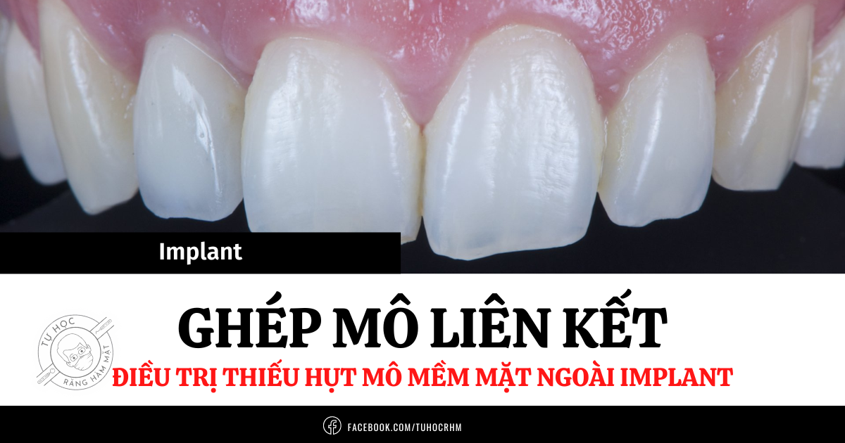 Ghép Mô Liên Kết Trên Implant: Kỹ Thuật Phẫu Thuật Phục Hình (2026)
