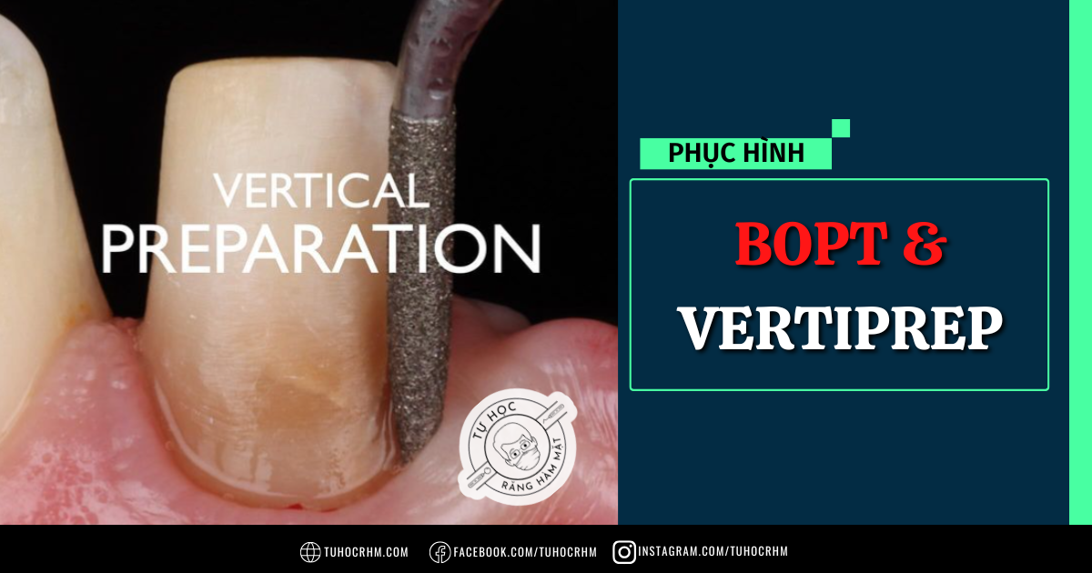 BOPT & Vertiprep: Kỹ Thuật Mài Sửa Soạn Theo Chiều Dọc (Slide 2026)