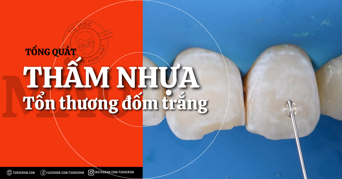 Thấm Nhựa (Resin Infiltration) Trị Đốm Trắng: Nguyên Lý & Quy Trình (2026)