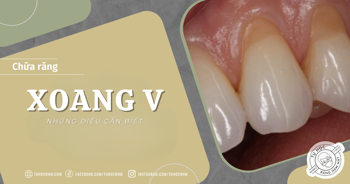 Xoang V (NCCL): Nguyên Nhân & Phác Đồ Trám Cổ Răng Chuẩn (2026)