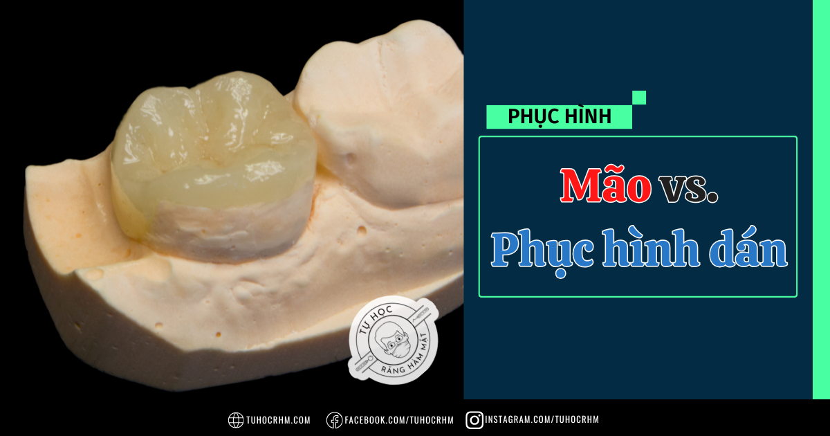 Mão Răng vs Phục Hình Dán: Tại Sao Nên Chọn Trên Nướu? (2026)