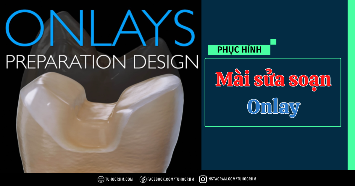 Kỹ Thuật Mài Sửa Soạn Onlay Dán: Nguyên Tắc & Quy Trình (2026)