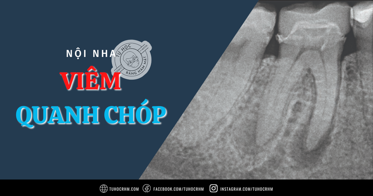 Viêm Quanh Chóp: Cơ Chế Bệnh Sinh & Nhiễm Trùng Nội Nha (2026)