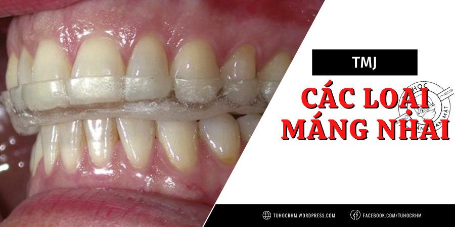 Máng Nhai Điều Trị TMJ: Khí Cụ Ổn Định & Khí Cụ Định Vị Phía Trước (2026)