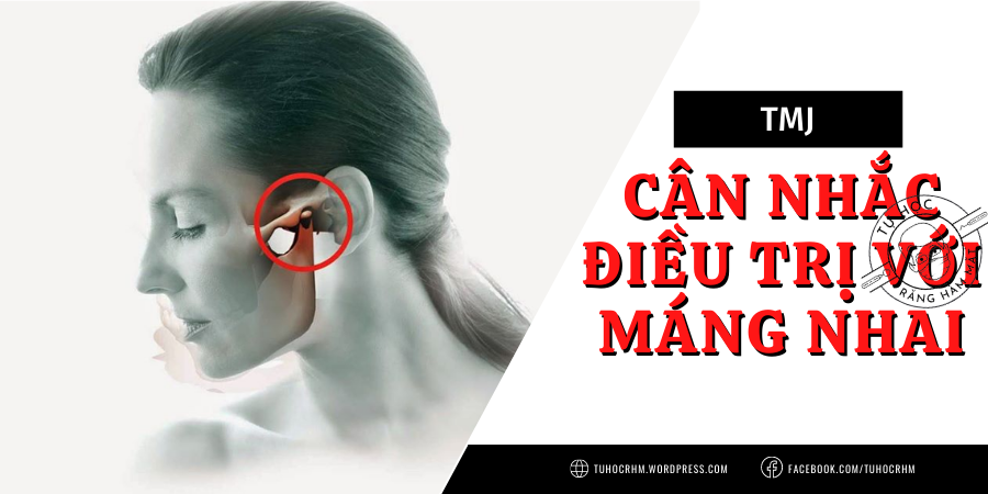 Cân Nhắc Khi Điều Trị TMJ Bằng Máng Nhai: 8 Lưu Ý Vàng (2026)