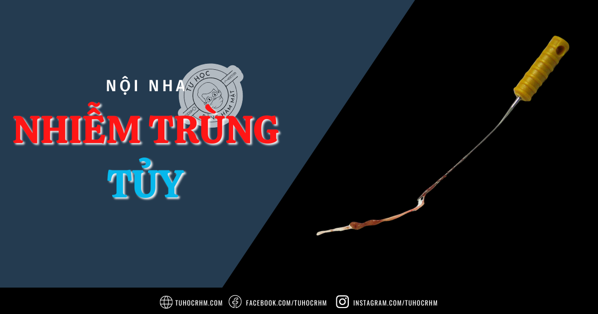Nhiễm Trùng Tủy Răng: Cơ Chế Bệnh Sinh & Vi Sinh Vật (2026)