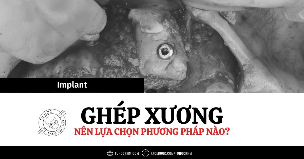Các Kỹ Thuật Ghép Xương Trong Implant & Cơ Sở Sinh Học (2026)