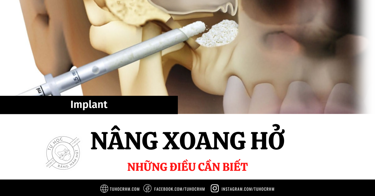 Kỹ Thuật Nâng Xoang Hở Trong Implant: Chỉ Định & Quy Trình (2026)