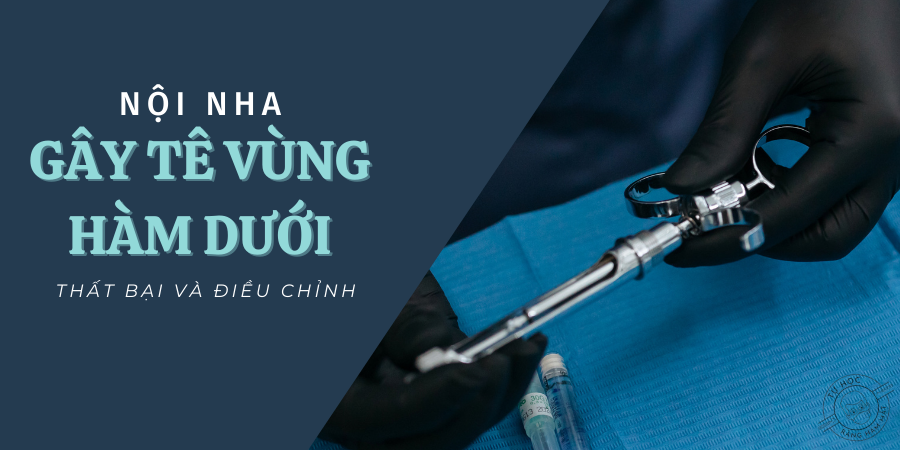 Thất Bại Gây Tê Vùng Hàm Dưới (IANB) Trong Nội Nha: Nguyên Nhân & Xử Trí