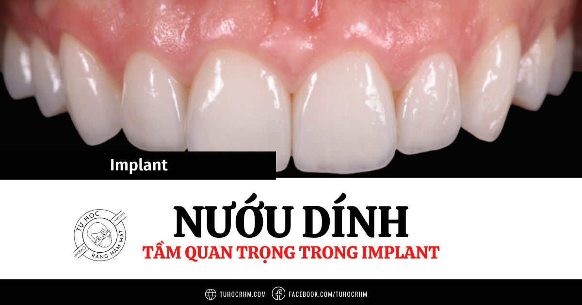 Nướu Dính Quanh Implant & Thuật Toán Quyết Định Lâm Sàng (2026)