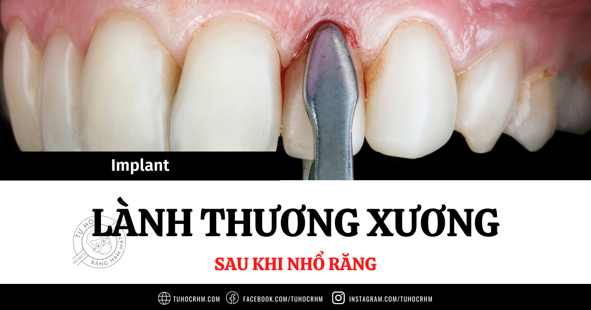 Lành Thương Sau Nhổ Răng: Quá Trình & Sự Thay Đổi Xương Ổ (2026)