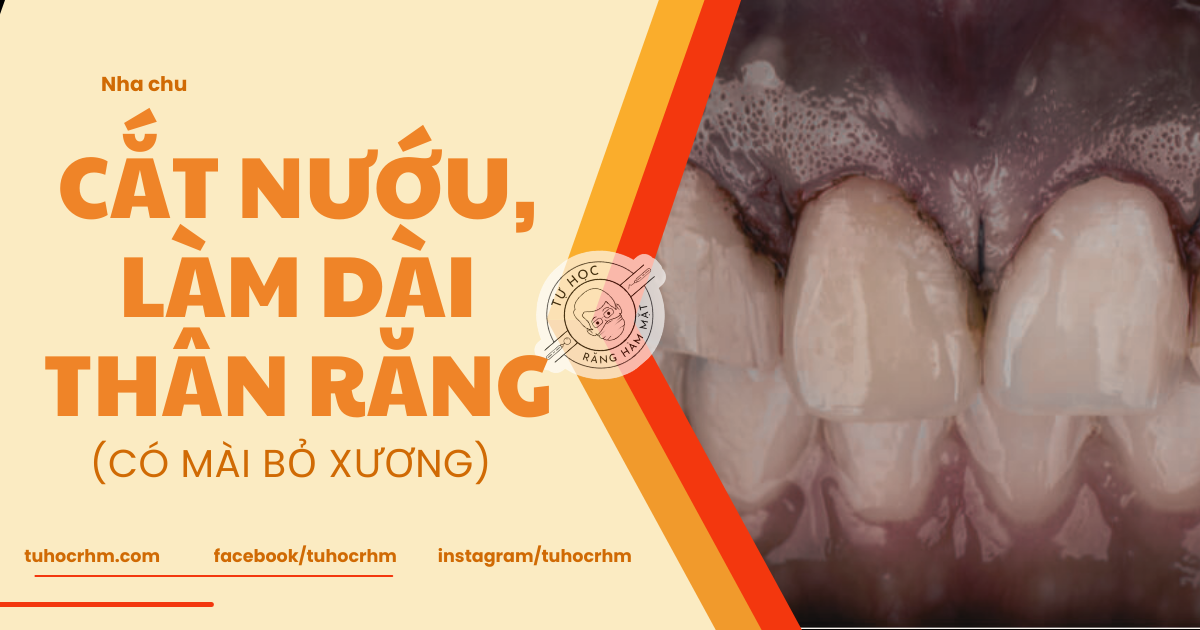 Phẫu Thuật Cắt Nướu, Mài Xương Ổ Làm Dài Thân Răng (Cập Nhật 2026)