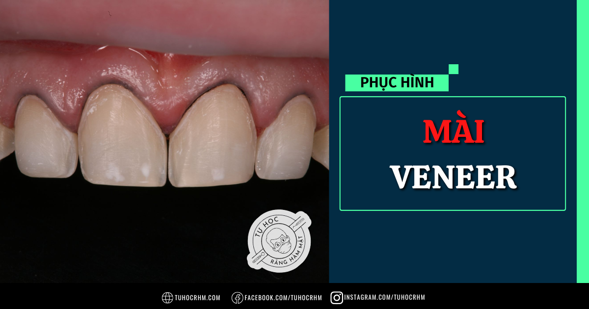 Cách Mài Sửa Soạn Veneer Chuẩn Y Khoa: Hướng Dẫn 10 Bước (2026)