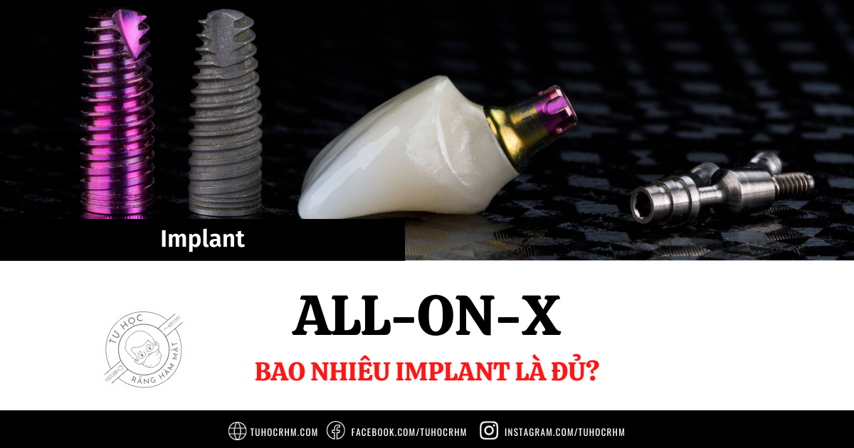 All-on-X: Số Lượng Implant Bao Nhiêu Là Đủ? Nên Cắm 4 Hay 6 Trụ? (2026)