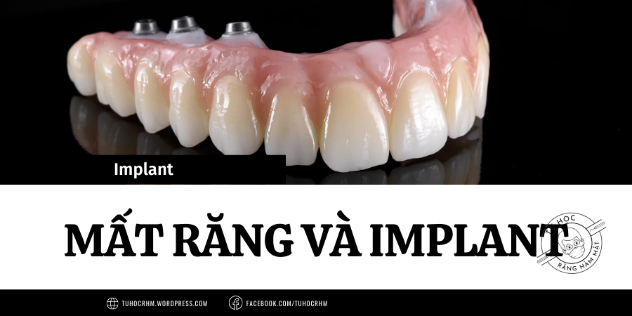 Mất Răng và Implant: Hậu Quả & Kỹ Thuật Bảo Tồn Xương (2026)