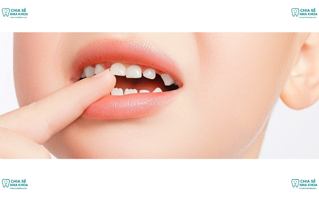 Thứ Tự Thay Răng Vĩnh Viễn Diễn Ra Như Thế Nào? Lịch Mọc Chuẩn