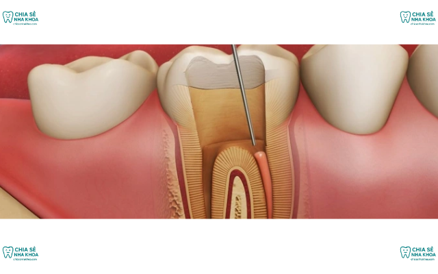 Răng Bị Chết Tủy: Dấu Hiệu Nhận Biết & Các Cách Điều Trị