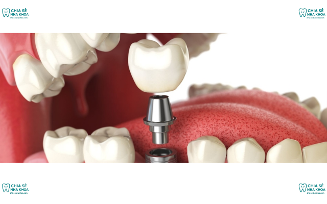 Trồng Răng Implant Có Đau Không? Giải Mã Nỗi Lo Người Mất Răng