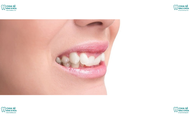 Khớp Cắn Sâu Là Gì? Nguyên Nhân & Các Phương Pháp Điều Trị
