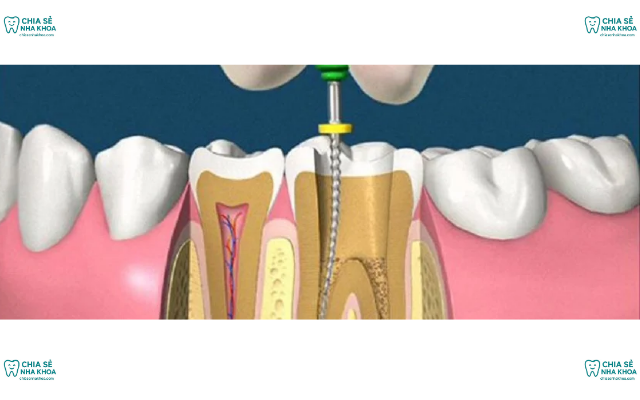 Điều Trị Tủy: Giải Pháp Bảo Tồn Răng Thật Hiệu Quả Nhất