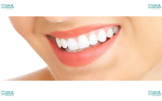Tẩy Trắng Răng Sau Khi Niềng Có Hại Không? Thời Điểm Chuẩn