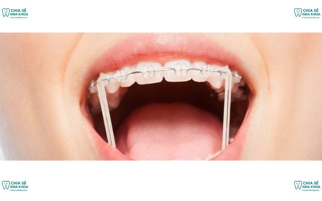 Nuốt Phải Dây Cung Niềng Răng Có Sao Không? Cách Xử Lý Nhanh