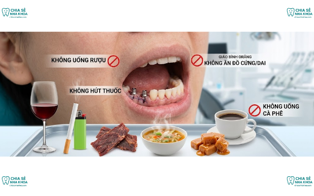 Cắm Implant Kiêng Ăn Gì? Thực Đơn Giúp Trụ Tích Hợp Nhanh (2026)