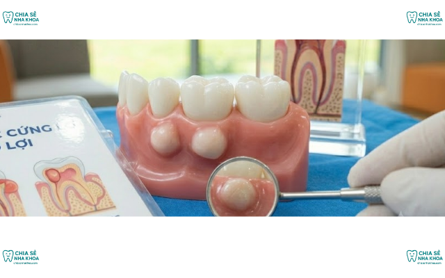 Nổi Cục Cứng Ở Lợi: Các Nguyên Nhân Và Phương Pháp Điều Trị (2026)