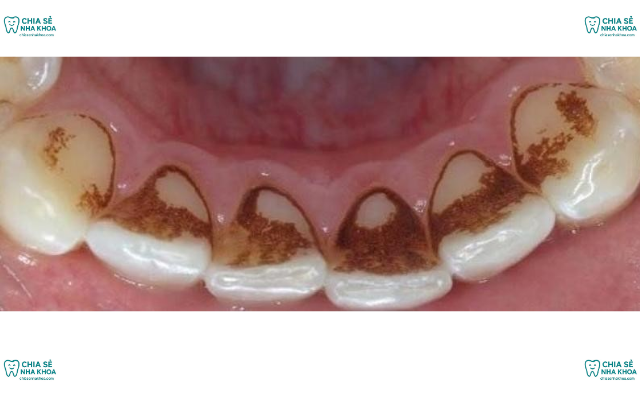 Răng Bị Đen Ở Mặt Trong Do Đâu? Cách Khắc Phục Triệt Để (2026)