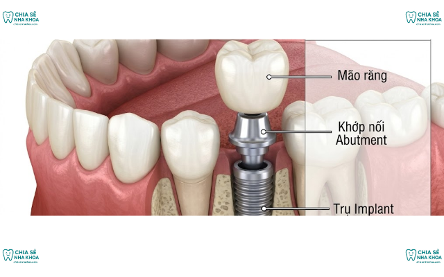 7 Bước Bảo Vệ Trụ Implant An Toàn Bền Chắc Trọn Đời (2026)
