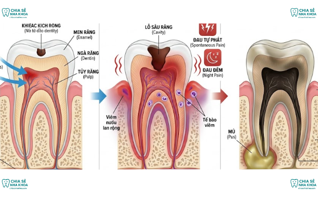 Viêm Tủy Răng: Nguyên Nhân, Dấu Hiệu & Biến Chứng Nguy Hiểm (2026)
