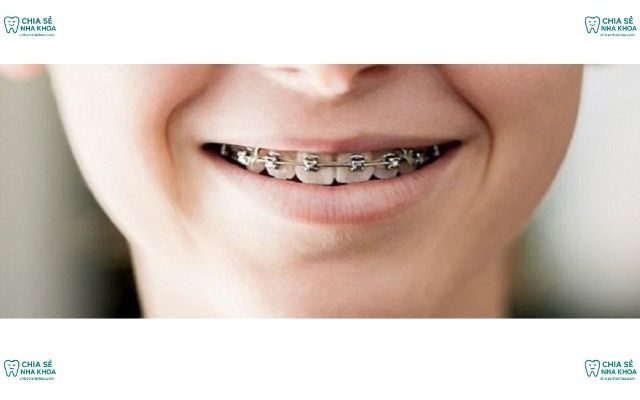 Độ Tuổi Nào Niềng Răng Tốt Nhất? Thời Điểm Vàng Chỉnh Nha (2026)