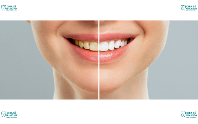 Tẩy Trắng Răng Có Làm Hỏng Men Răng Không? Lưu Ý Quan Trọng (2026)