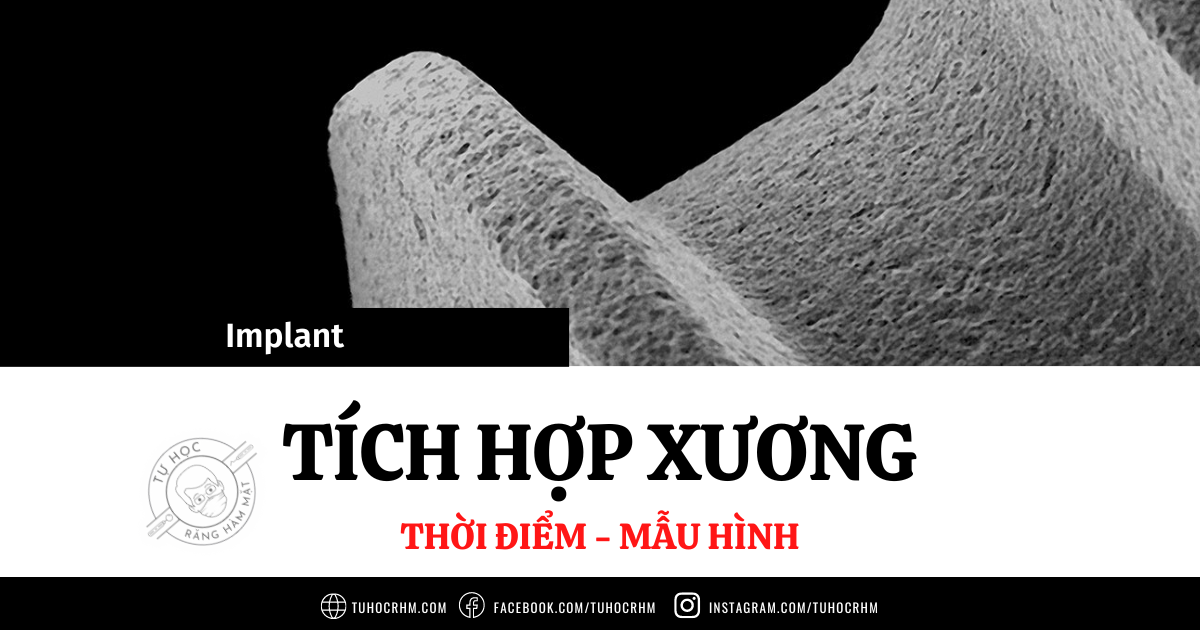 Tích Hợp Xương Trong Implant Là Gì? Các Giai Đoạn Lành Thương (2026)