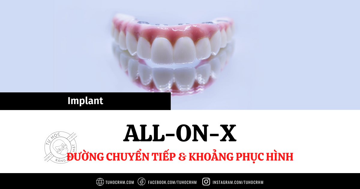 Lên Kế Hoạch All-on-X: Xử Lý Đường Chuyển Tiếp & Khoảng Phục Hình (2026)