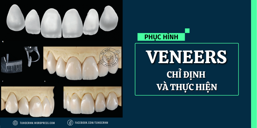 Veneer Sứ: Chỉ Định, Kỹ Thuật Mài APT & Quy Trình Dán (2026)