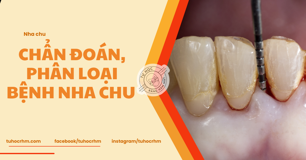 Implant Phục Hình Lai (Xi Măng / Bắt Vít): Ưu Điểm & Quy Trình Chế Tác