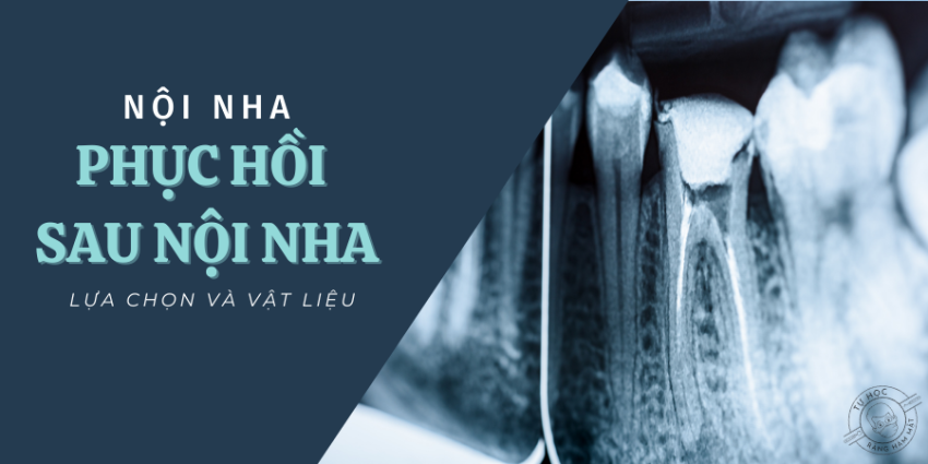 Phục Hồi Răng Sau Nội Nha: Cùi Giả, Chốt Sợi & Xi Măng (2026)